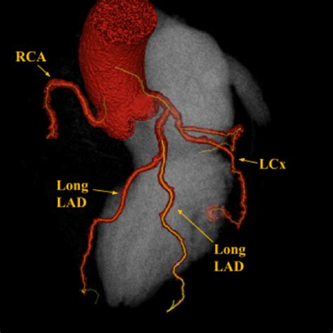 plaque lv|Left Anterior Descending Artery .